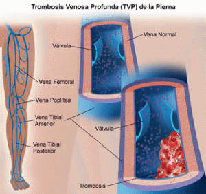 trombosi venosa